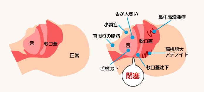 睡眠時無呼吸症候群の原因