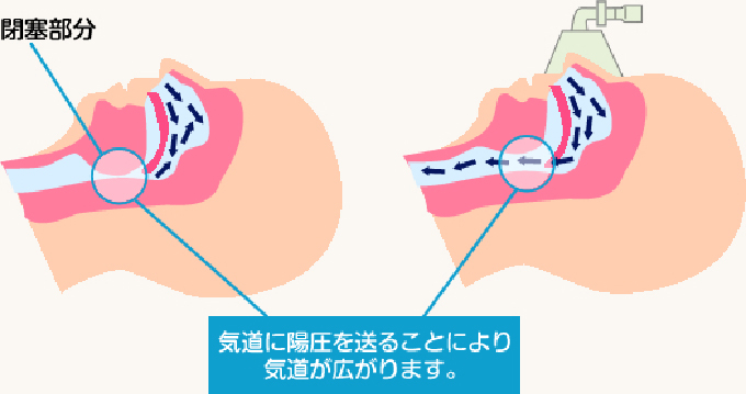 CPAP（シーパップ）療法