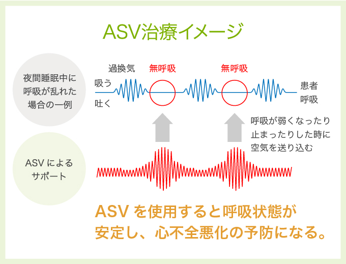 ASV（エーエスブイ）療法